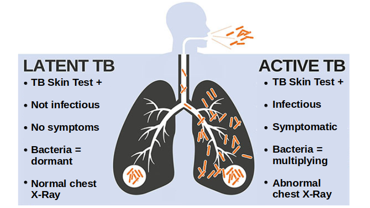 Illustrative comparison between active and latent TB